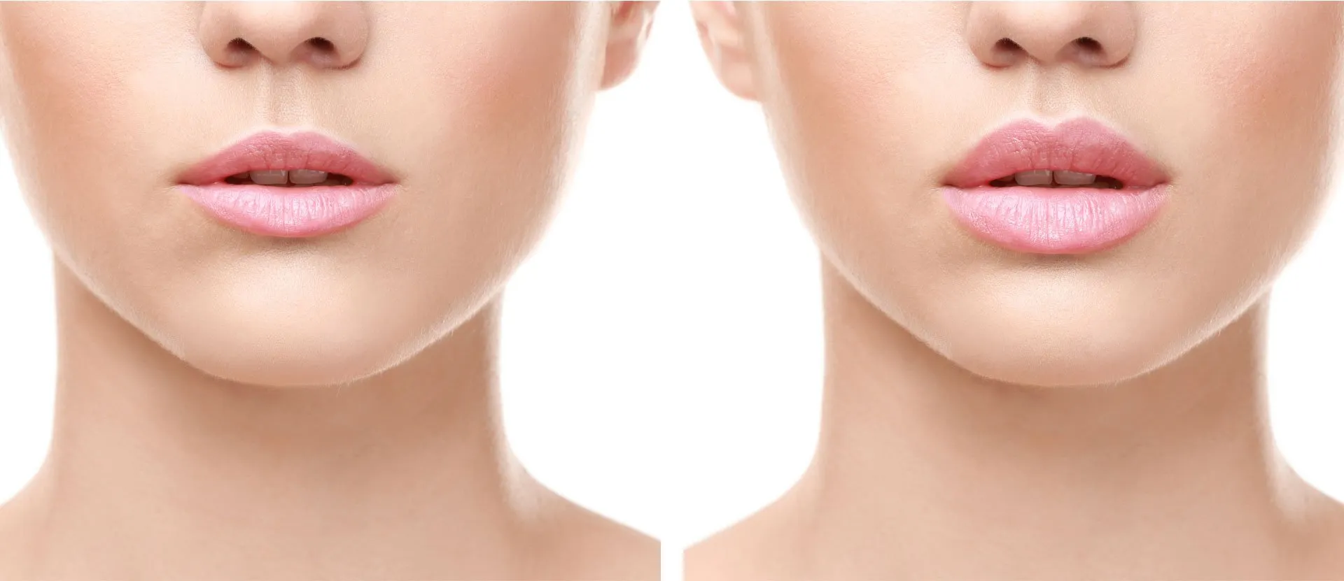 Wirral Lip Fillers - Lips/Peri Oral